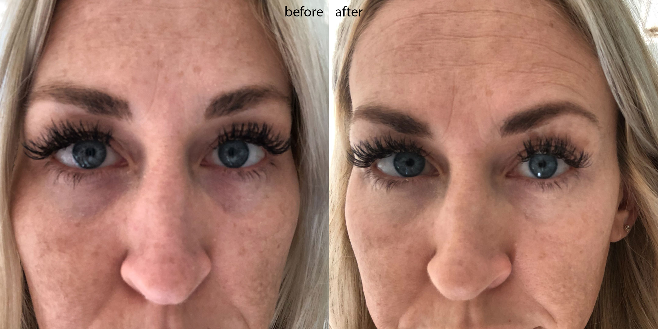 actual results from the olay brightening eye cream. up close and personal with my tired mom eyes | thelovedesignedlife.com #olayeyes #beforeandafter #darkcircles